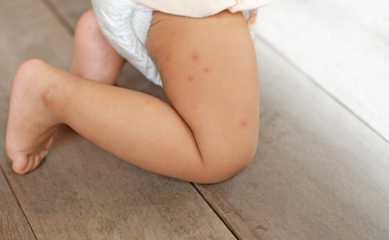 What Does Chicken Pox Look Like at the Start? What Does Chicken Pox Look Like at the Start